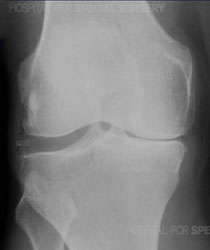medial knee 2